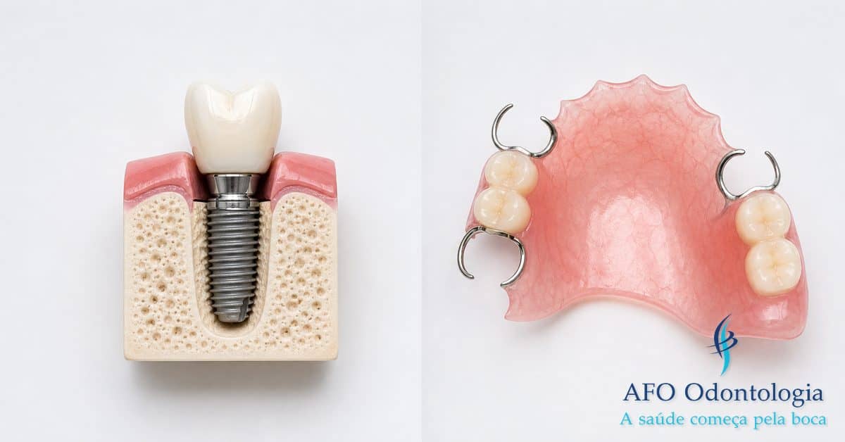 Comparação entre implante dentário e prótese — opções de reabilitação oral para dentes perdidos, Taboão da Serra