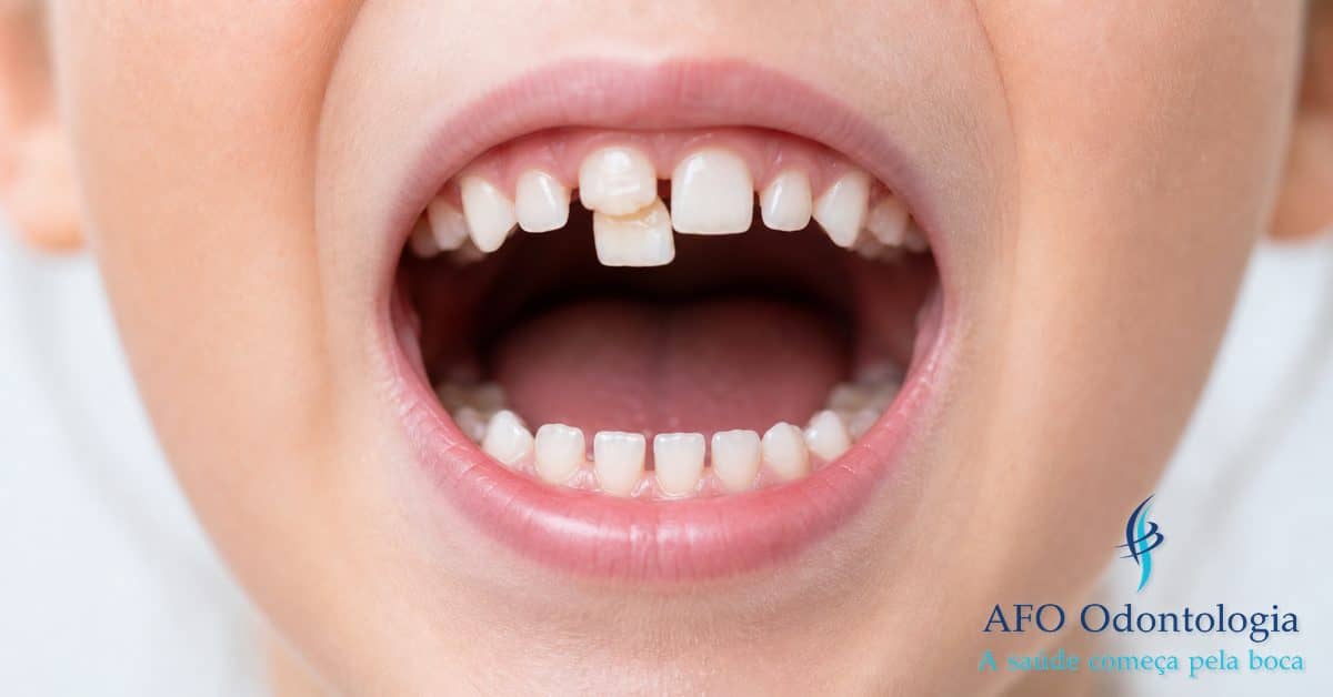 Criança com dente de tubarão — dente permanente nascendo atrás do dente de leite, Taboão da Serra