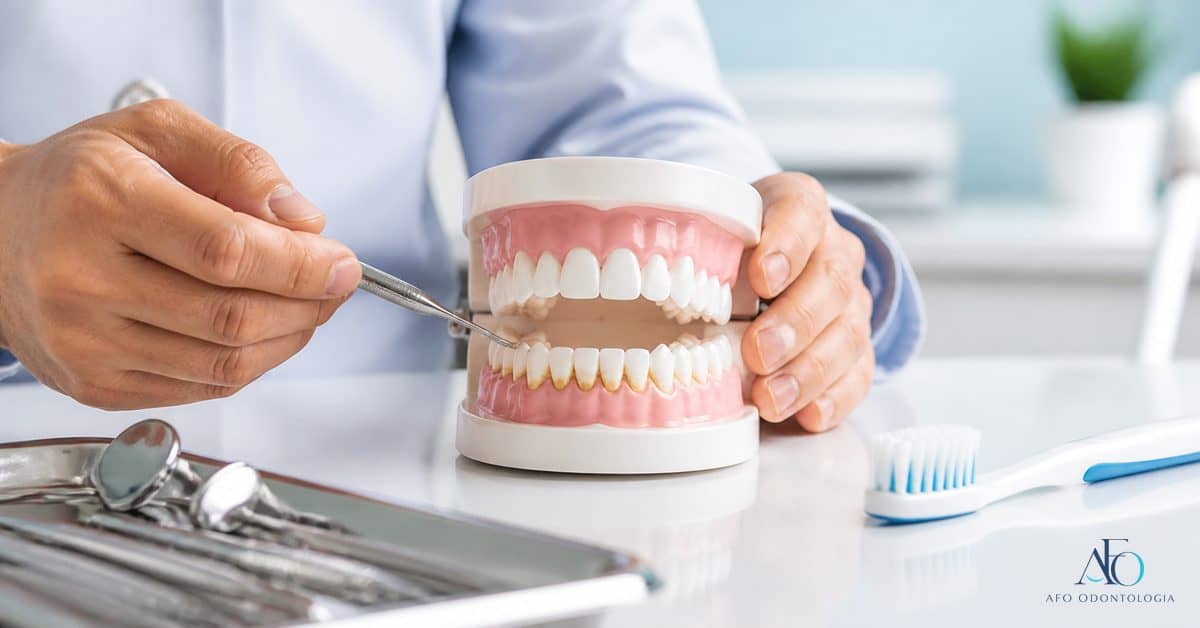 Modelo dental com tartaro sendo explicado por dentista