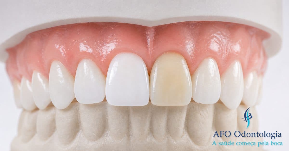 Clareamento dental com restaurações — como planejar para harmonizar cor, Taboão da Serra