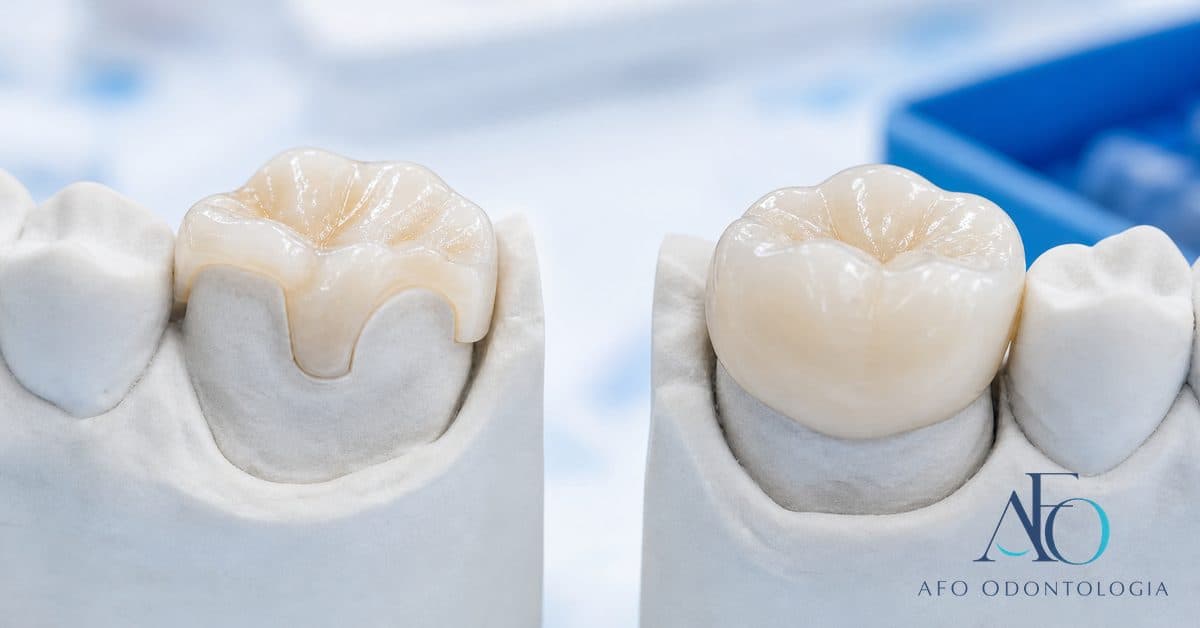 Comparação entre bloco cerâmico (onlay) e coroa dentária total sobre bancada odontológica, ilustrando as duas opções de reabilitação em Taboão da Serra