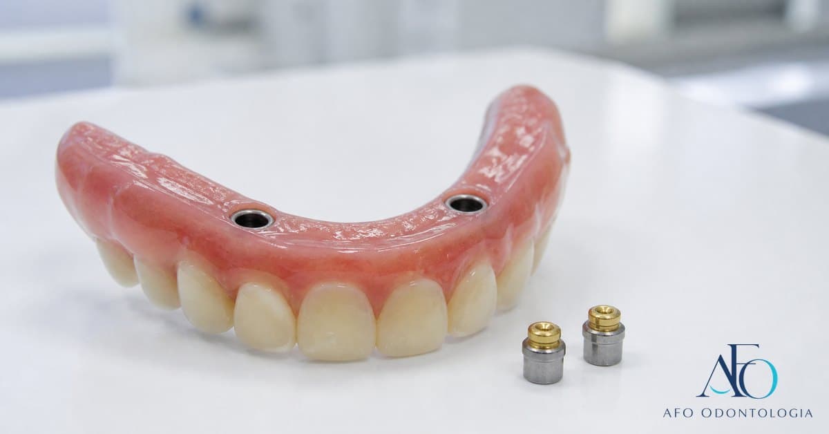 Overdenture com encaixes sobre implantes em bancada clínica, mostrando prótese de encaixe em Taboão da Serra