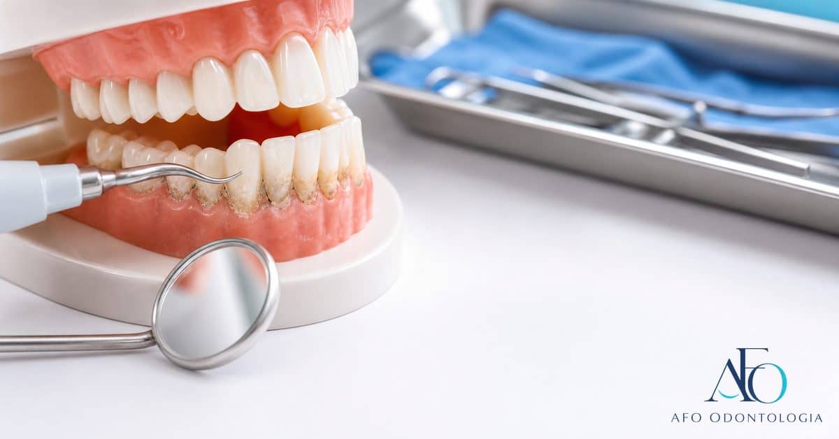 Raspagem dental com instrumentos periodontais removendo tártaro da superfície dental em Taboão da Serra