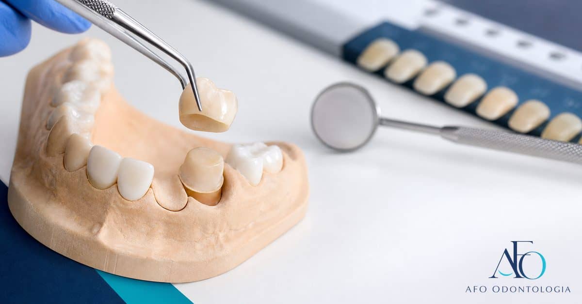 Coroa dentária sobre dente preparado, ilustrando reabilitação protética em Taboão da Serra