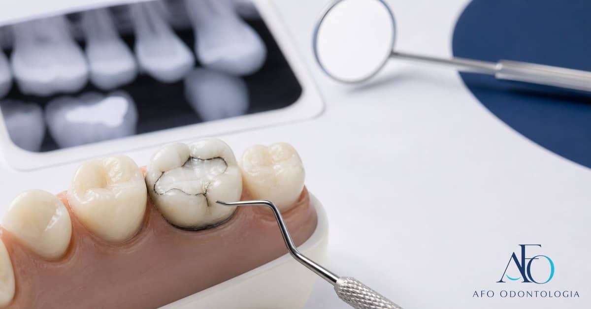 Modelo dental com restauracao infiltrada e avaliacao de carie em Tabao da Serra