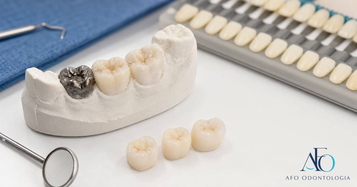 Modelo dental com restauracao antiga escura para avaliacao em Tabao da Serra