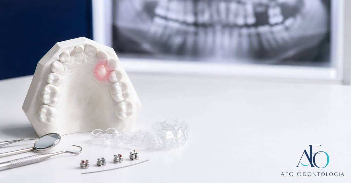 Modelo dental e radiografia mostrando canino incluso para ortodontia em Tabao da Serra