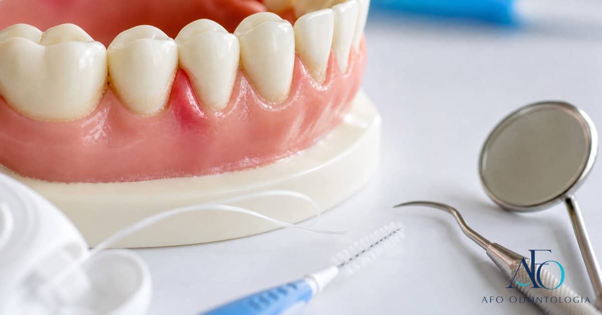 Modelo dental com gengiva inchada entre os dentes e escova interdental em Tabao da Serra
