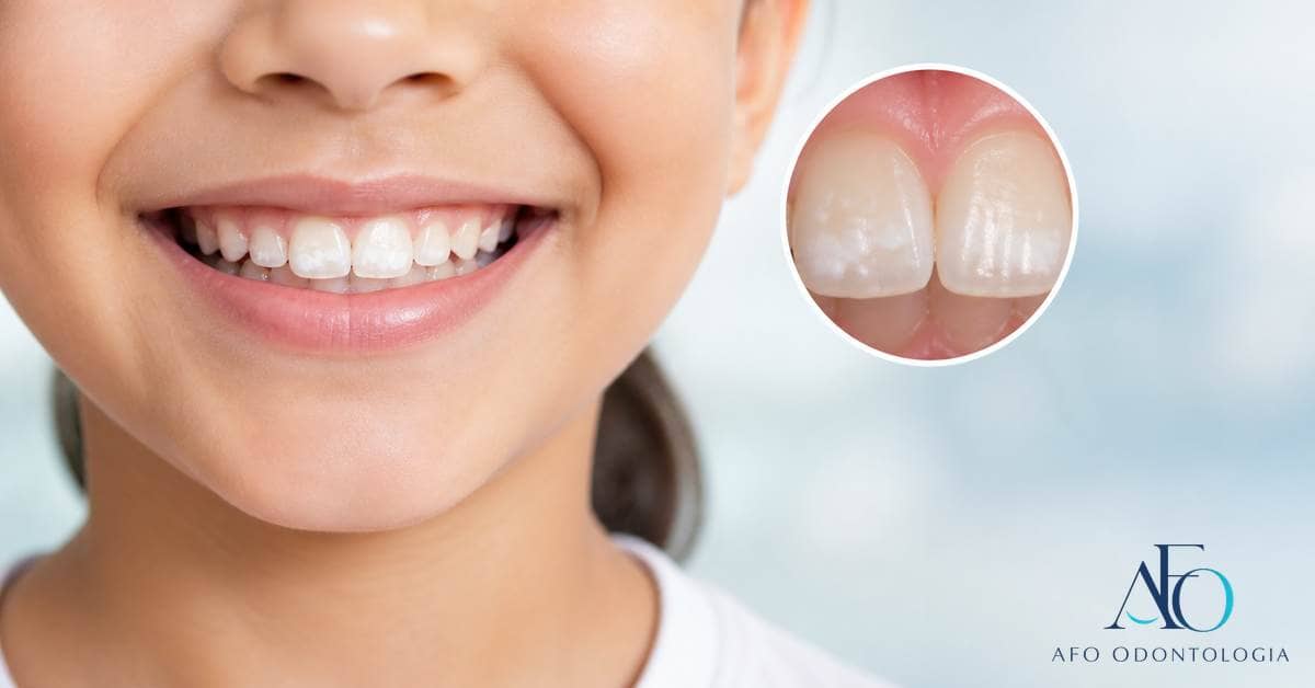 Ilustração educativa de manchas brancas em dentes infantis sem aparência de diagnóstico
