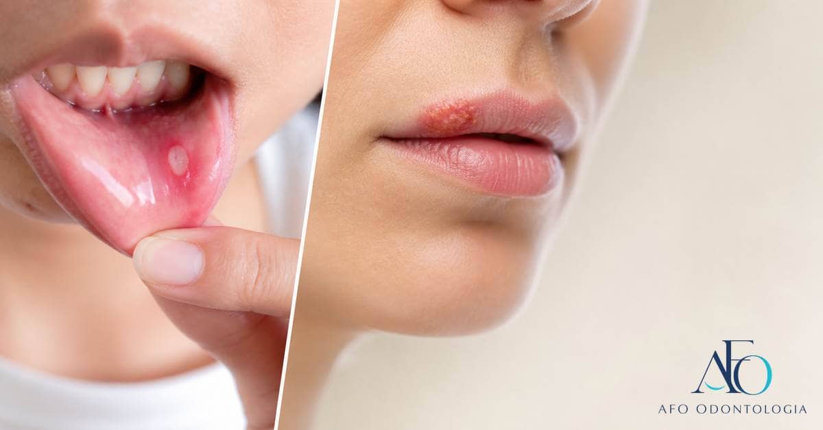 Painéis didáticos abstratos comparando áreas comuns de afta e herpes sem foto clínica
