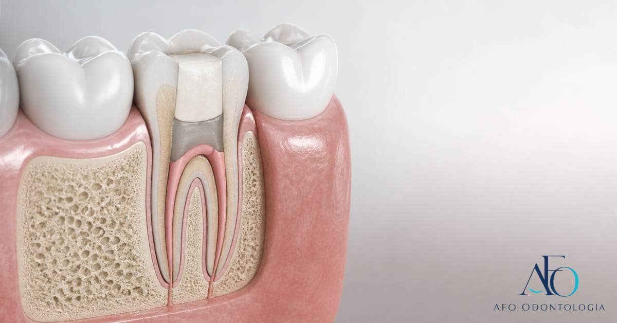 Dente em corte esquemático com mudança de tonalidade após tratamento endodôntico