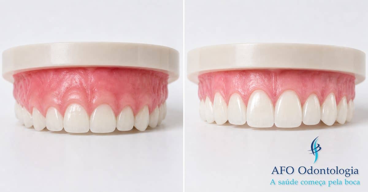 Sorriso gengival — excesso de gengiva visível ao sorrir, tratável com gengivectomia ou cirurgia ortognática, Taboão da Serra