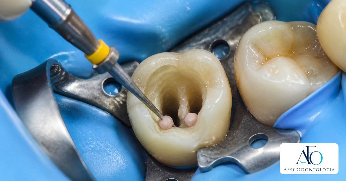 Dente em tratamento endodôntico visto em modelo odontológico