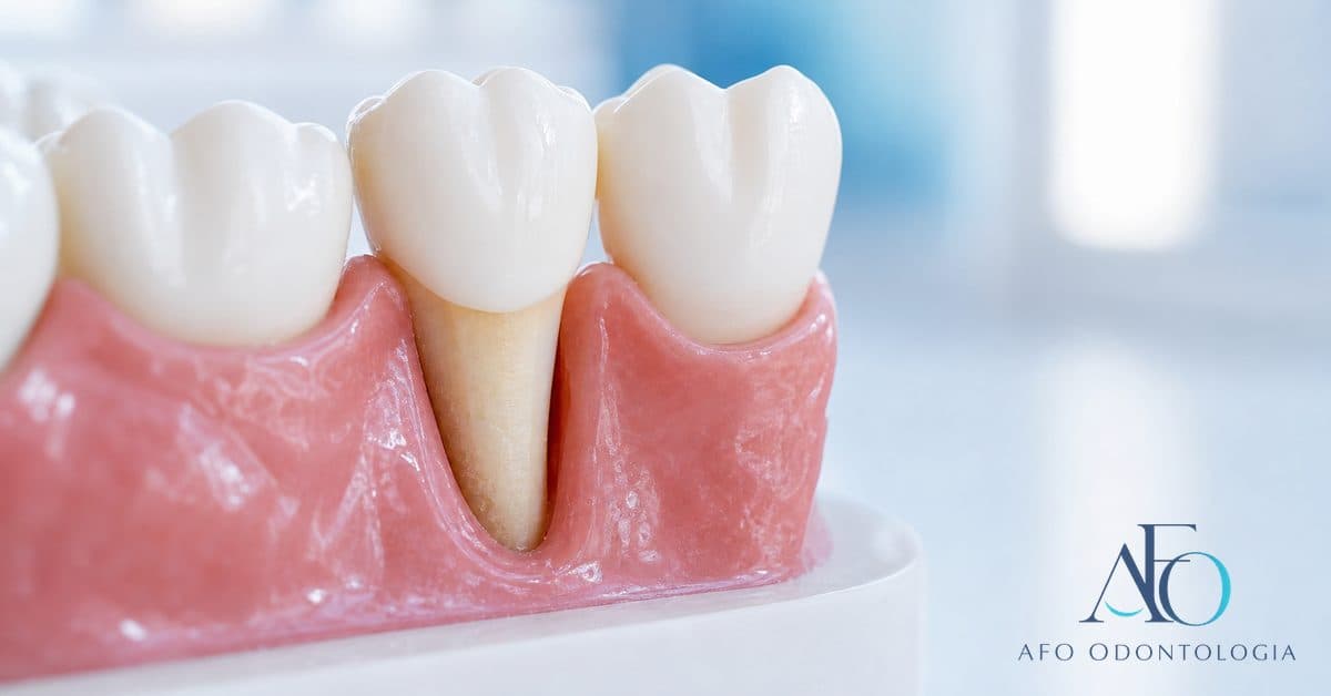 Close-up de dente com retração gengival expondo a raiz, ilustrando o que fazer contra a gengiva retraída em Taboão da Serra
