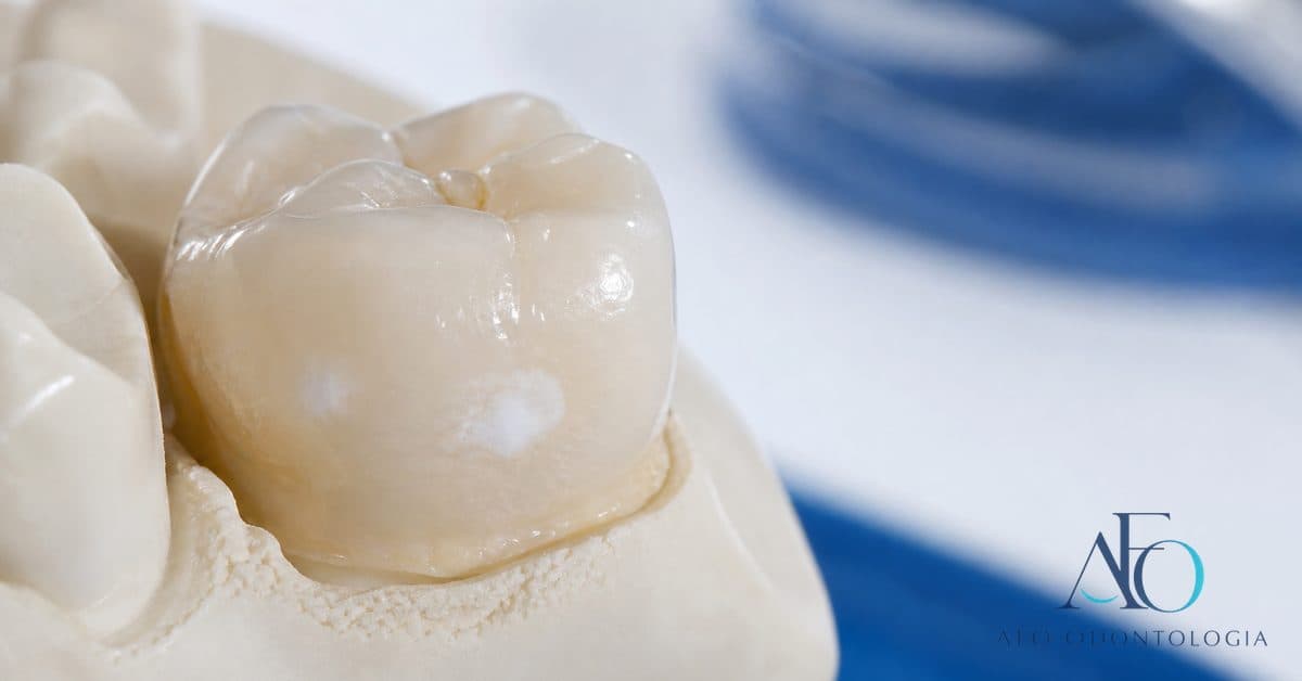 Close-up de dente anterior com mancha branca opaca no esmalte, ilustrando cárie inicial, fluorose ou hipoplasia em Taboão da Serra