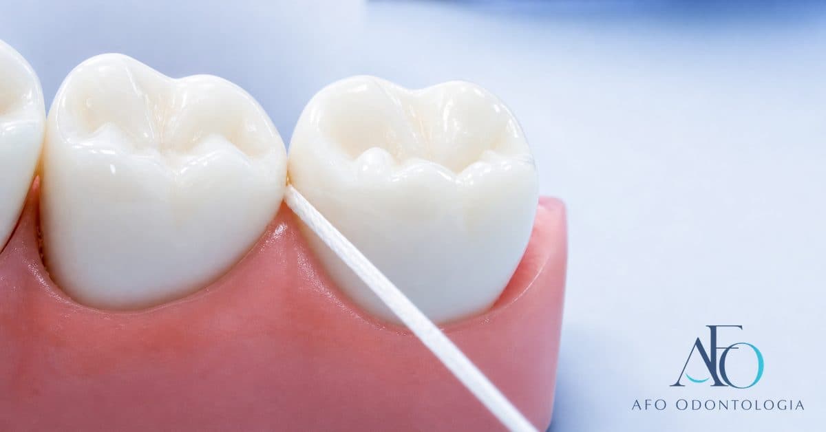 Radiografia bite-wing evidenciando cárie interproximal entre os dentes, região de difícil visualização a olho nu, em Taboão da Serra