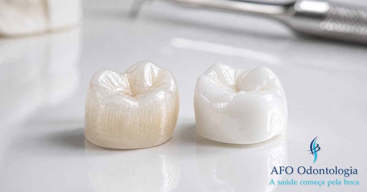 Coroa dentária — resultado de consultas regulares e tratamento preventivo com dentista, Taboão da Serra