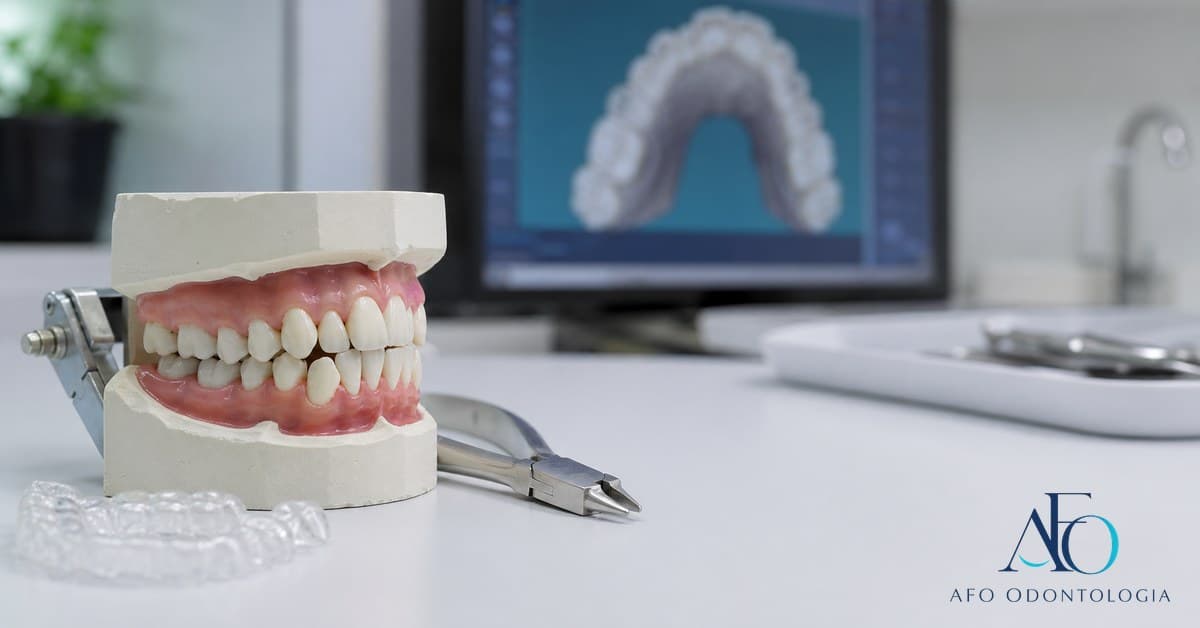 Modelo dental com dentes apinhados e aparelho ortodôntico, explicando tratamento em Taboão da Serra