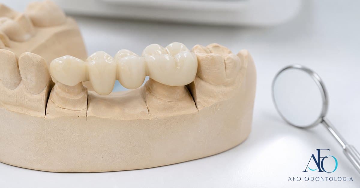 Ponte fixa dentária entre dentes pilares, ilustrando reposição de dentes sem implante em Taboão da Serra