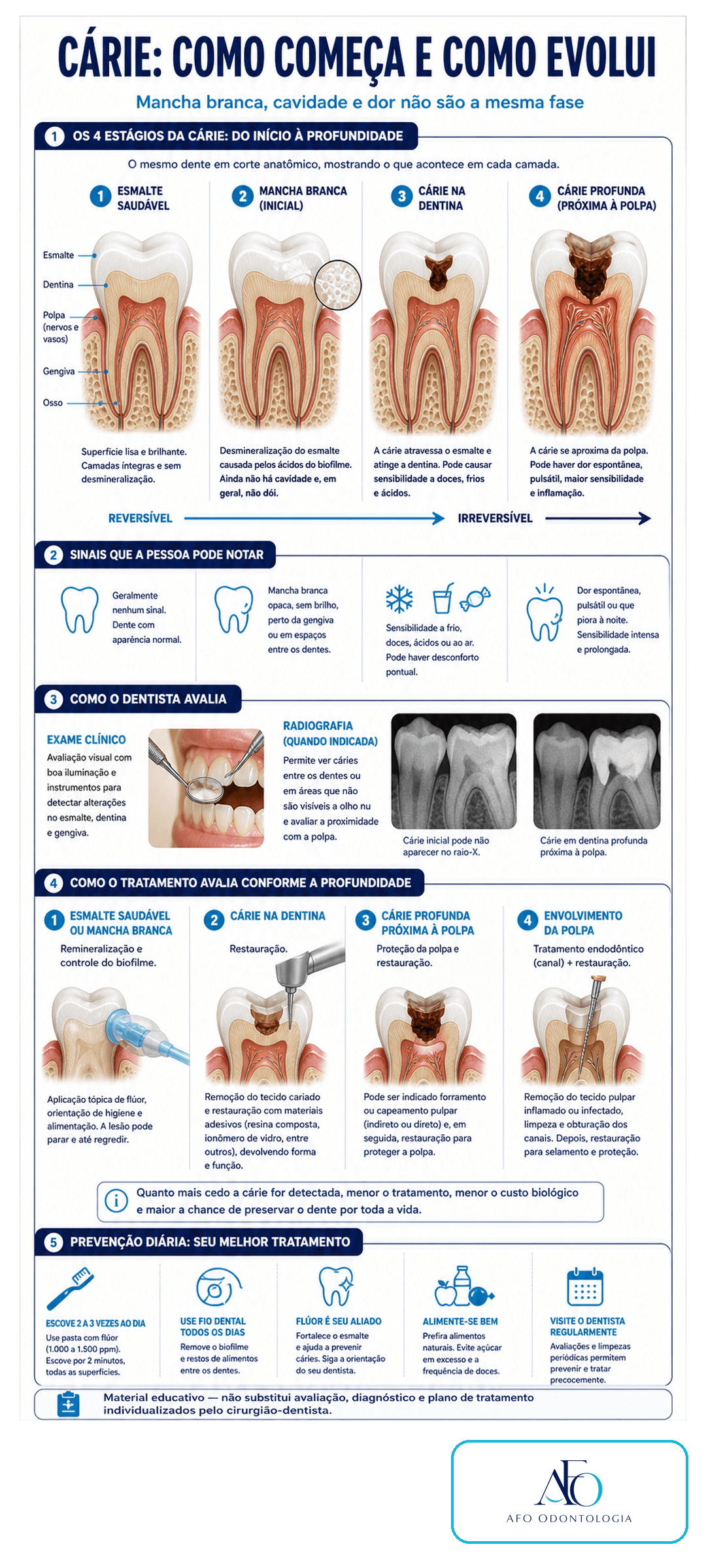 Infográfico sobre estágios da cárie, mancha branca, dentina, polpa, diagnóstico e prevenção